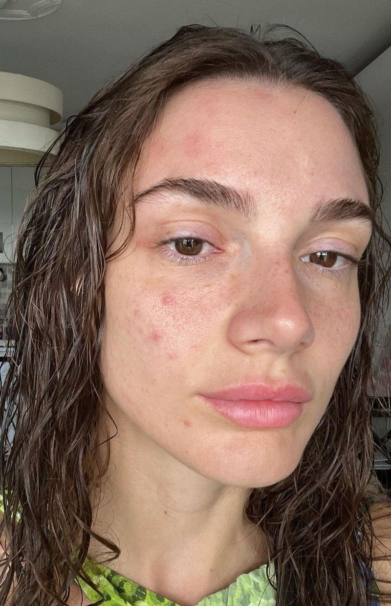 <p><strong>Dehydrated, Tight & Rough Skin</strong></p>