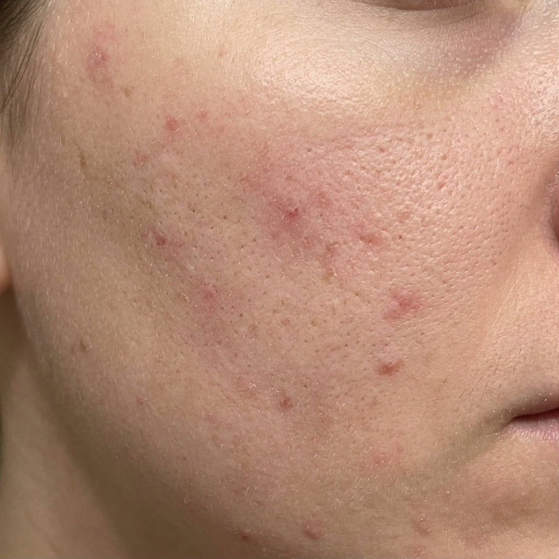 <p><strong>Uneven Skin Tone</strong></p>